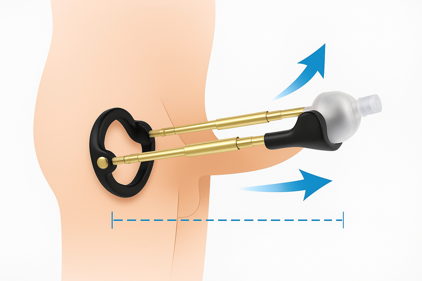 Agrandisseur orthopédique Nickson